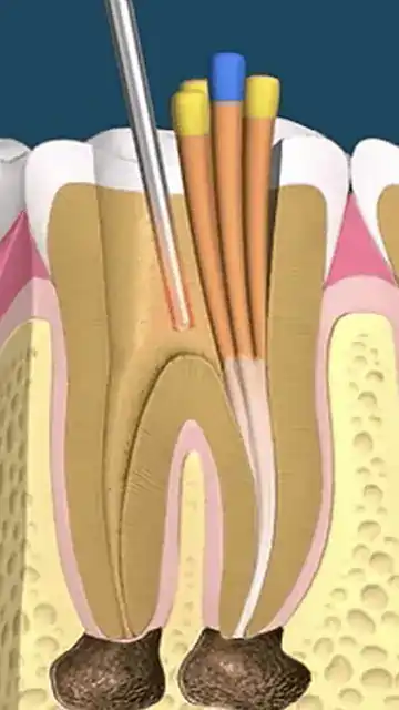 Endodontinis danties šaknies kanalo plombavimas įkaitinant į kanalą įvestą gutaperčą.