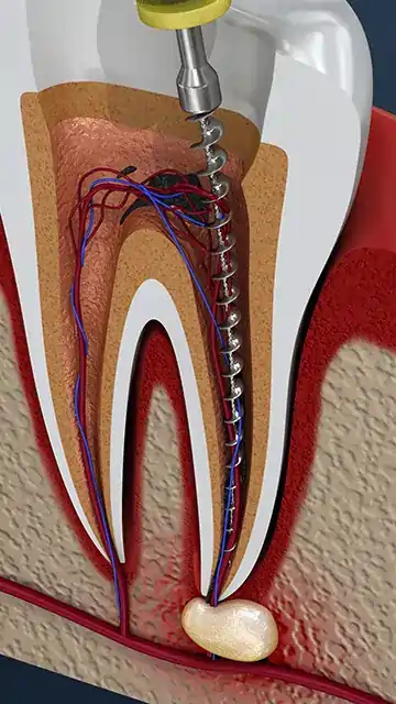 Endodontinis dantų šaknų kanalo valymas ir pulpos pašalinimas pasinaudojant failu.