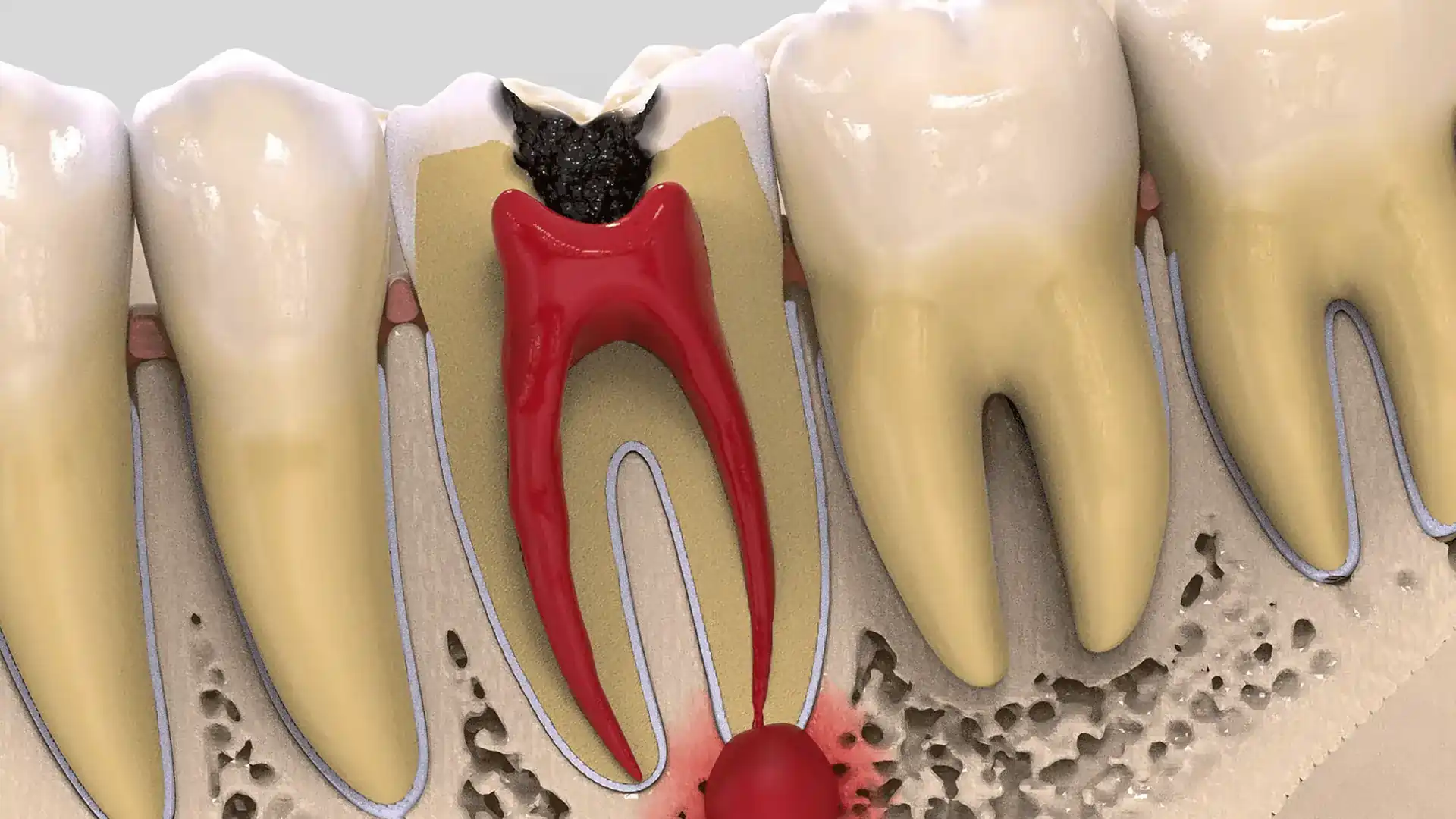 Pulpitas – danties nervo uždegimas. Iliustracija parodanti bakterijų patekimą į pulpą ir infekcijos bei skausmo židinio susidarymą.