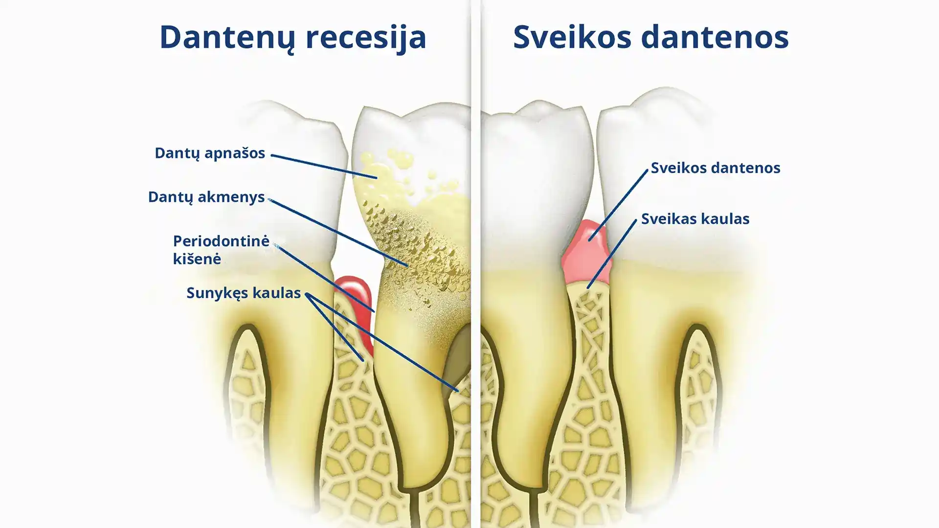 Dantenų recesijos simptomų palyginimas su sveikomis dantenomis.