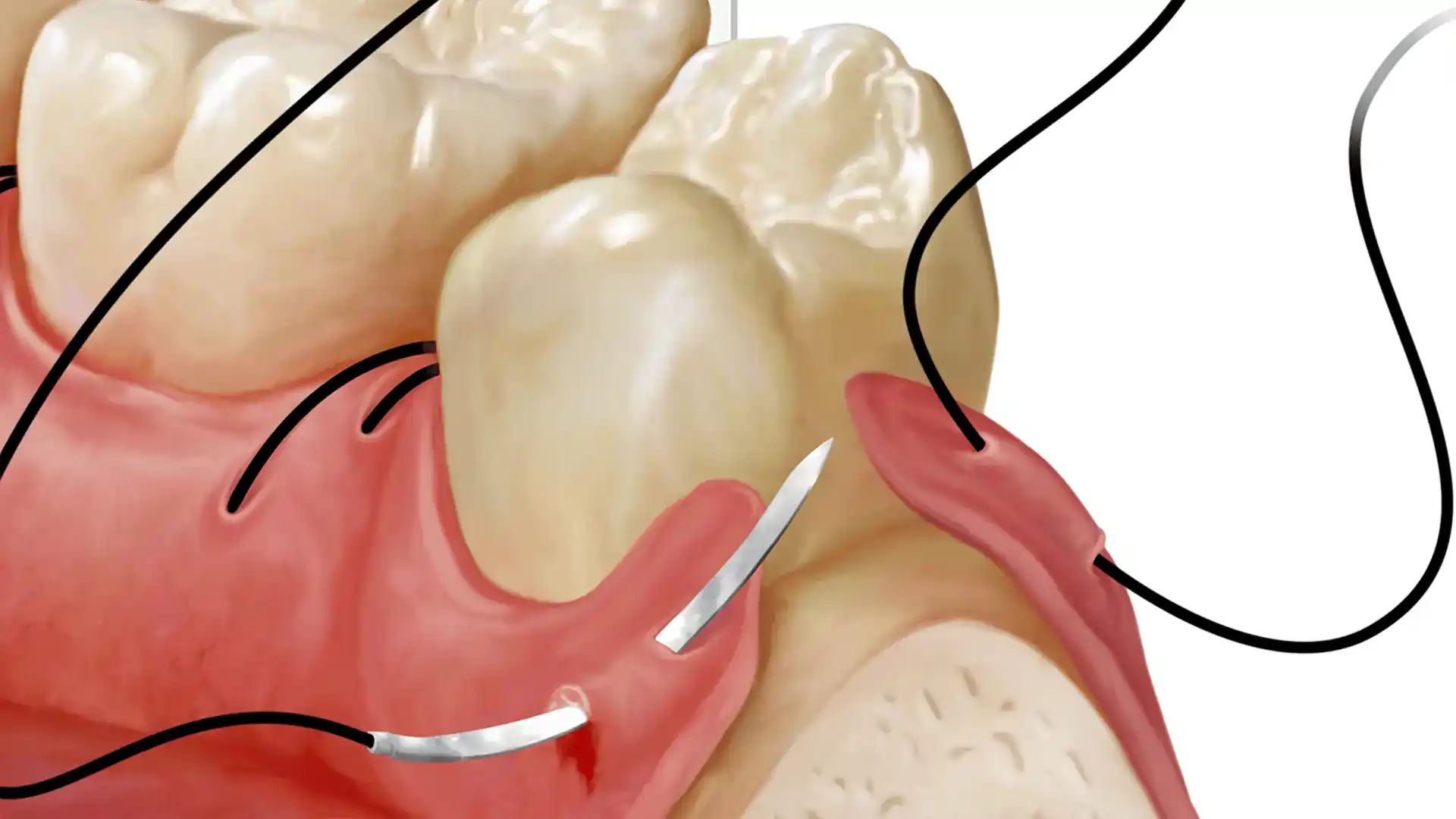 Dantenų susiuvimas po mukogingivalinės dantenų persodinimo operacijos, skirtos dantenų recesijai gydyti.