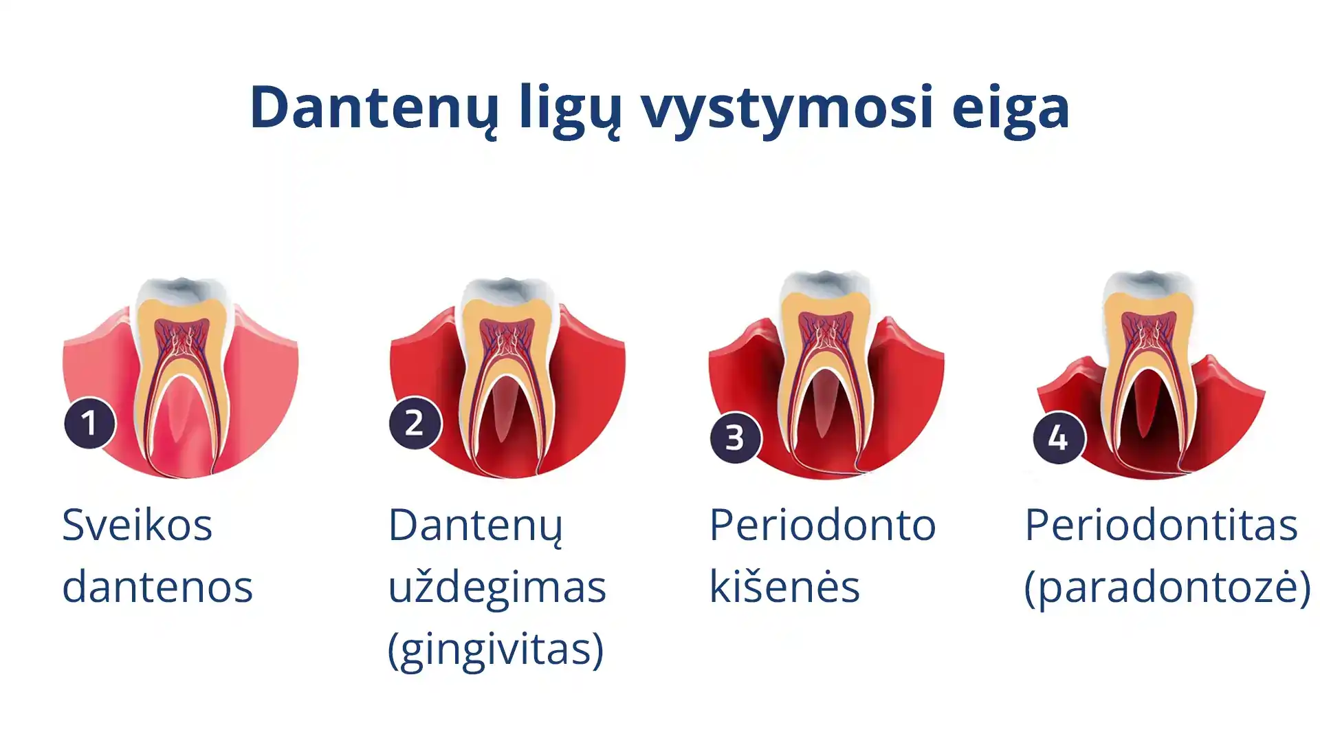 Dantenų ligų vystymosi eiga: sveikos dantenos, dantenų uždegimas (gingivitas), periodonto kišenės, periodontitas (paradontozė).