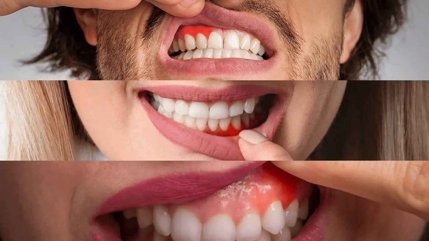 Dantenų uždegimas (gingivitas) – trys klinikiniai atvejai su matomais patinimo ir paraudimo simptomais.