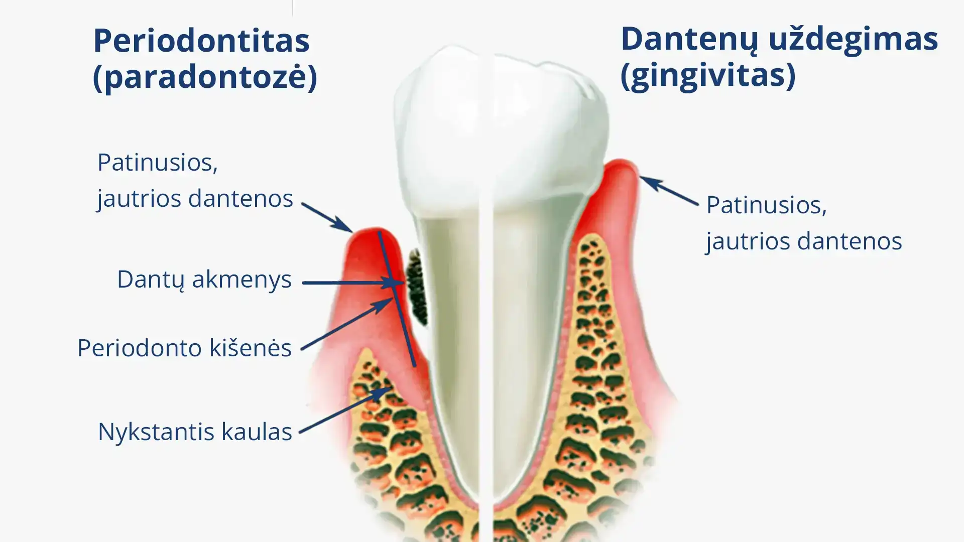 Periodontito ir dantenų uždegimo (gingivito) skirtumai.